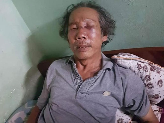 Triệu tập bảo vệ chung cư đánh người già nhập viện