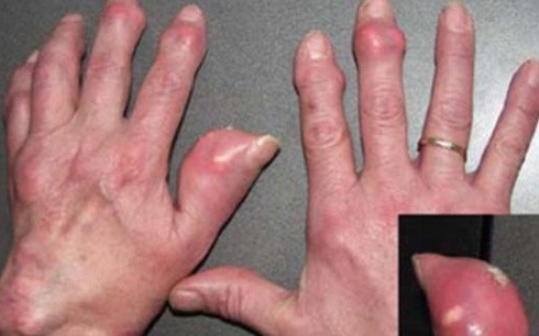Bị bệnh gout nên ứng phó thế nào?