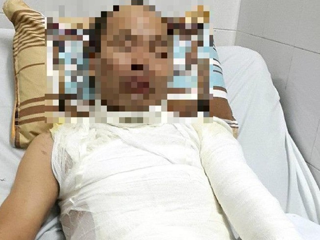 Điều tra vụ cha bị tạt axit trước mặt con gái tại Hà Nội