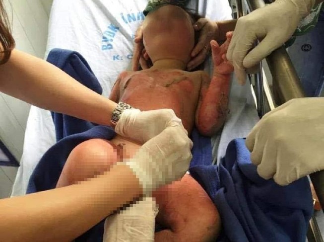 Thông tin mới vụ cô giáo dùng cồn dạy học làm 3 trẻ bỏng nặng