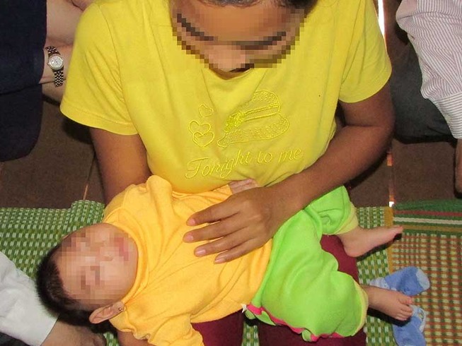 Xác định ca teo não đầu tiên do virus Zika