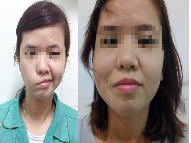Cô gái 20 năm mới dám cười
