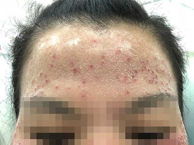 ‘Sát thủ’ làn da mang tên… corticosteroid!