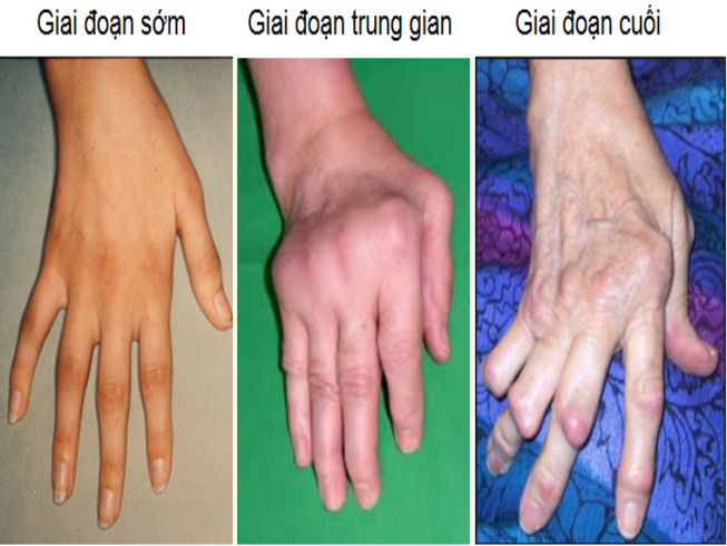 Bệnh gì dễ nhầm với gút?