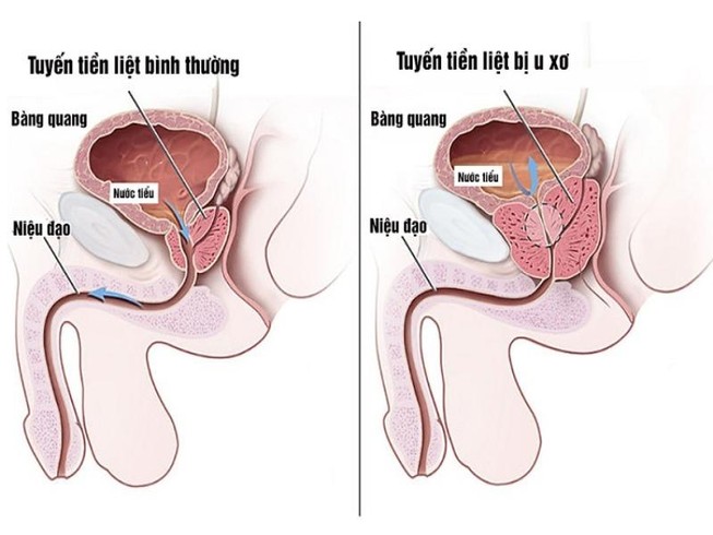 Tuyến tiền liệt bình thường và tuyến tiền liệt bị u xơ. Ảnh: Internet