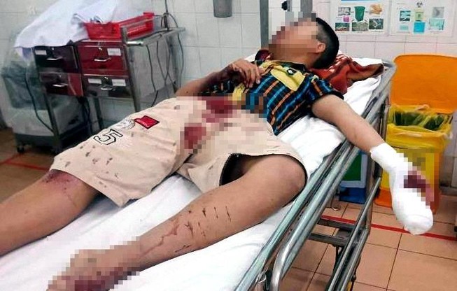 Dùng bột diêm để chế pháo, thiếu niên bị thương