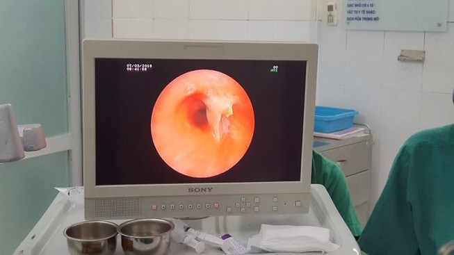 Ho suốt ba năm trời mới phát hiện bị mắc xương cá
