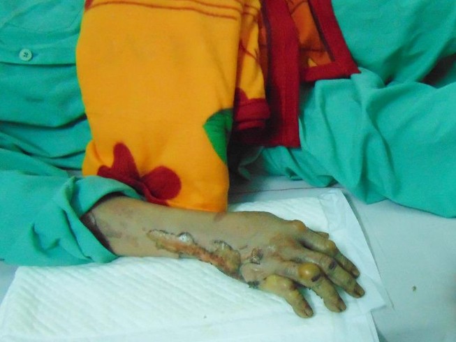 Hai mẹ con bị bỏng trong vụ cháy