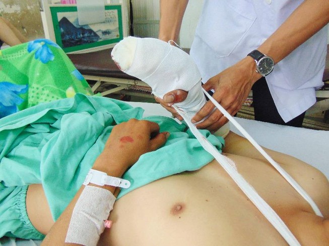 Thêm trường hợp nát bàn tay do pháo tự chế