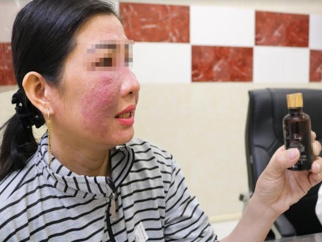 Mặt nham nhở do bôi mỹ phẩm 'trời ơi đất hỡi'