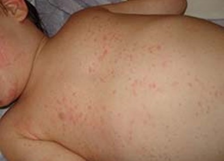 Cách "bảo vệ" trẻ trong dịch sởi