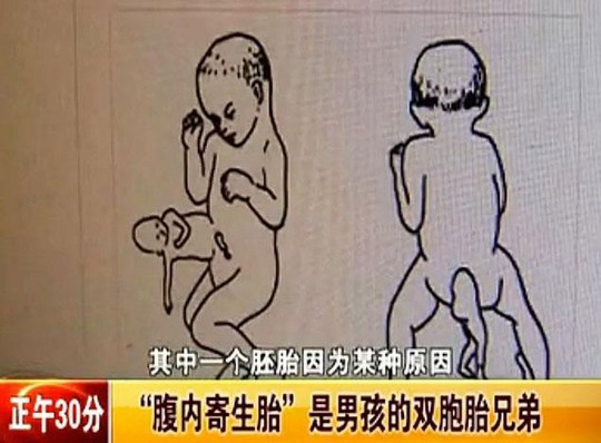 Bé trai 2 tuổi "mang thai" người anh em sinh đôi