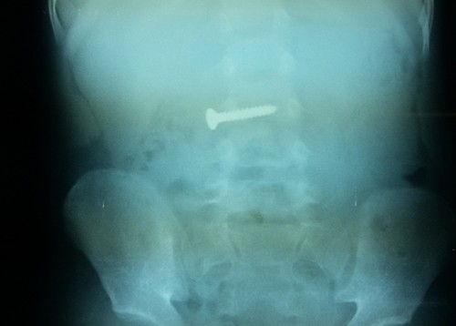 Phát hiện cây đinh dài 3 cm trong bụng bé 3 tuổi