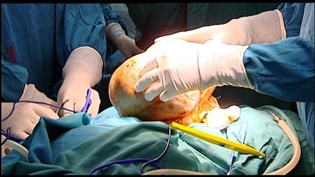 Phẫu thuật khối u nặng hơn 3 kg trên gương mặt nữ bệnh nhân
