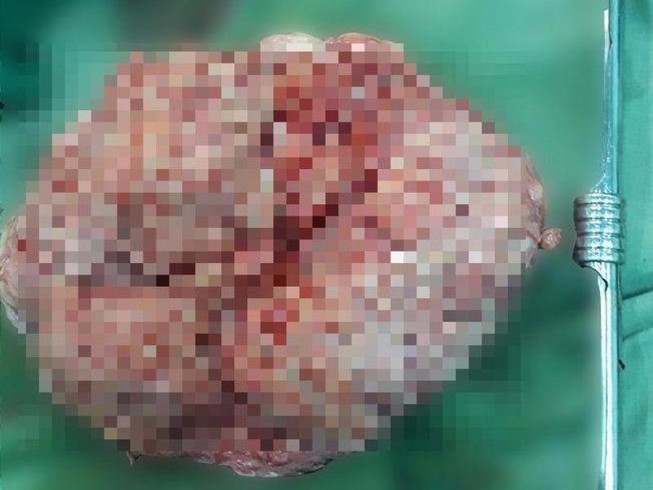 Khối u xơ gần 4kg cứ tưởng mang bầu 20 tuần