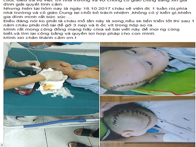 Bé 3 tuổi bị chấn thương sọ não ở trường mầm non