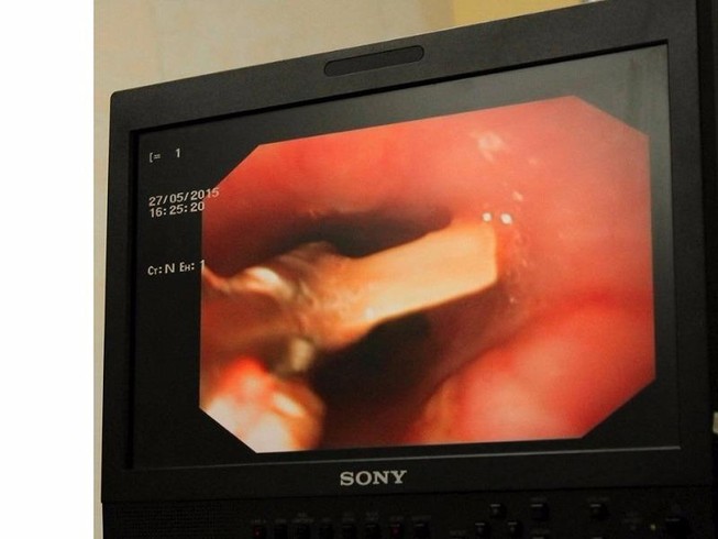 Xém chết vì hóc xương rồi ngồi đợi xương... tự tan
