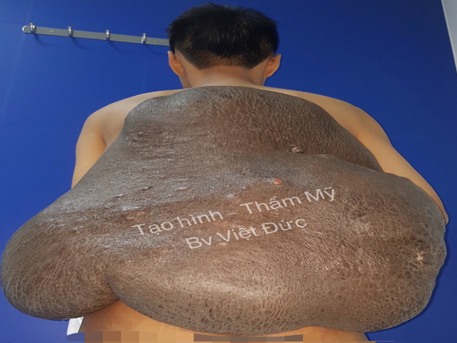 Kỳ lạ chàng trai mang 'mai rùa' nặng 15 kg suốt 26 năm