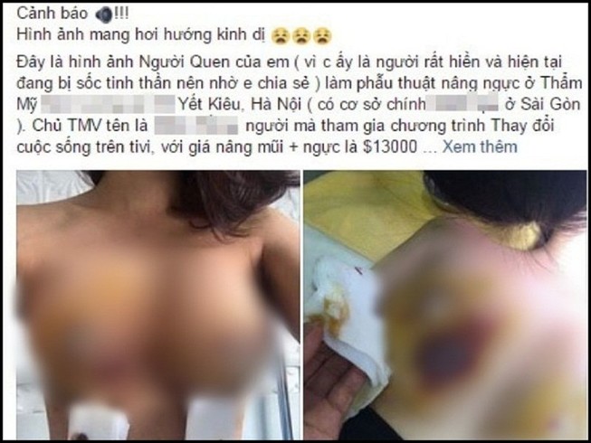 Nâng ngực xong nhập viện: Bộ Y tế khẳng định BV không sai