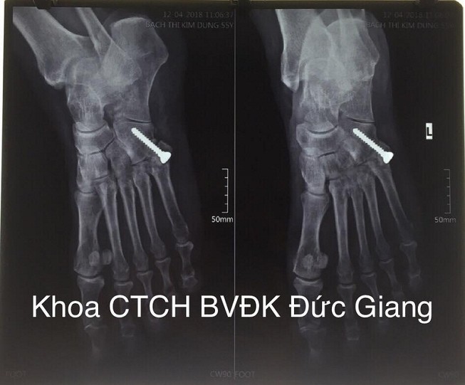Mang 'bệnh lạ' suốt 20 năm sau cú ngã trẹo chân