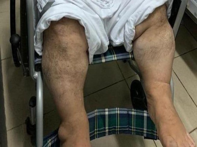 Lấy tĩnh mạch chân con cứu trái tim người bố lùn bẩm sinh