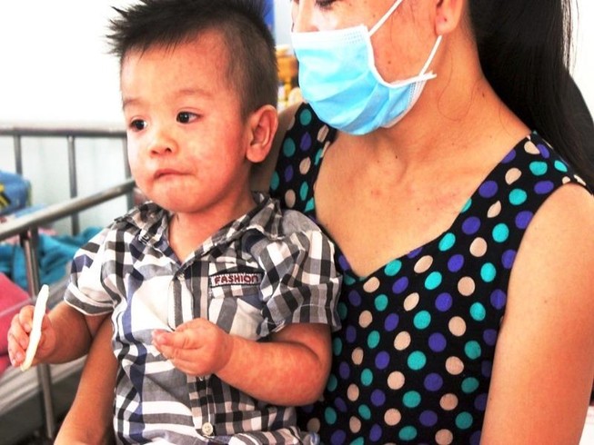 Tất tần tật cách phòng và chăm sóc bệnh sởi