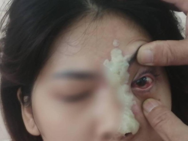Cô gái 21 tuổi mù mắt sau khi tiêm filler nâng mũi