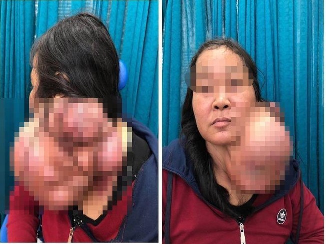 Khối u biến hình khổng lồ, hóa ác tính sau 25 năm