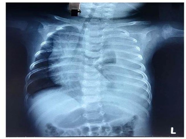 Bé 3 tháng bị rò nửa lít dịch đục như sữa vào phổi mỗi ngày