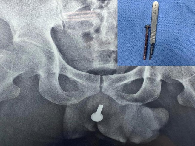 Đi cấp cứu vì bị bạn nhậu nhét đinh vít 6cm vào đường tiểu