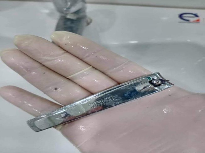 Thanh niên nuốt bấm móng tay phải đi cấp cứu