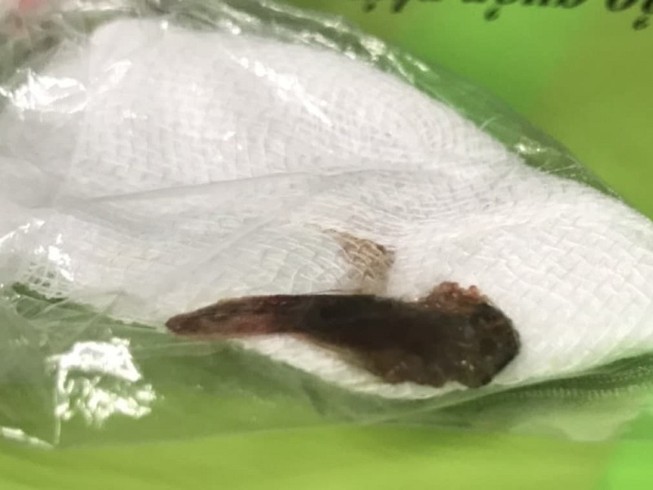 Dùng miệng gỡ lưới, bị cá dài 5,5 cm chui tọt vào phổi