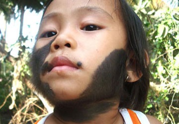 Một bé gái mọc đầy lông ở cổ