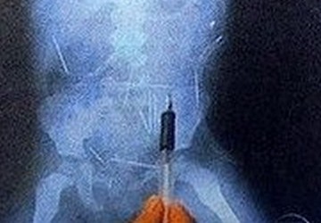 24 năm chung sống với 26 chiếc kim trong cơ thể