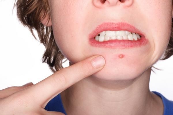 Cách điều trị mụn trứng cá - ảnh 1