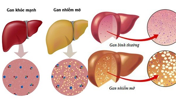Gan nhiễm mỡ - Bệnh thời hiện đại - ảnh 1