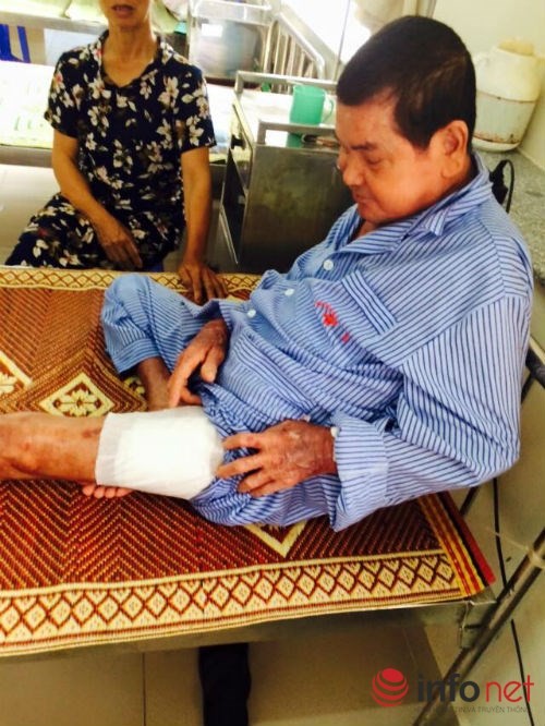 Một tuần bị nhọt, nhập viện bị cắt chân ngay lập tức - ảnh 2