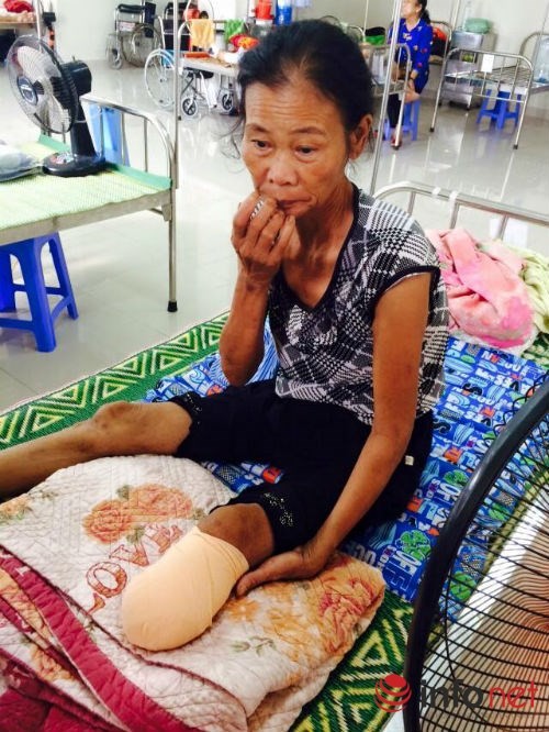 Một tuần bị nhọt, nhập viện bị cắt chân ngay lập tức - ảnh 1