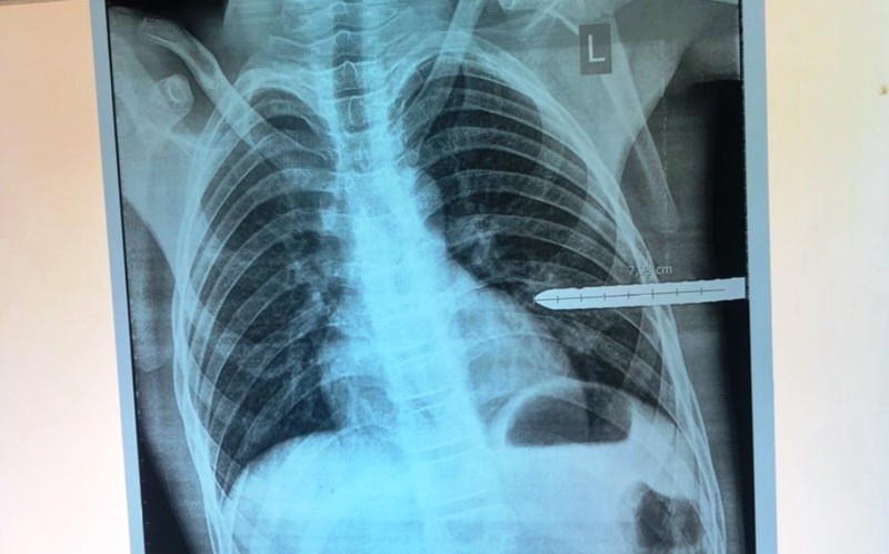 Cứu bé trai 13 tuổi bị thanh sắt dài đâm thủng phổi - ảnh 1