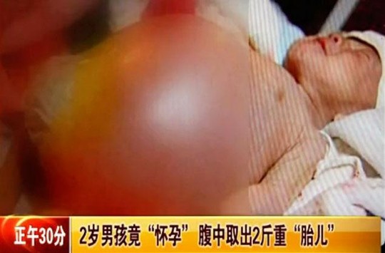 Bé Xiao Feng bụng phình to bất thường. Ảnh: v.youku.com Bé Xiao Feng bụng phình to bất thường. Ảnh: v.youku.com