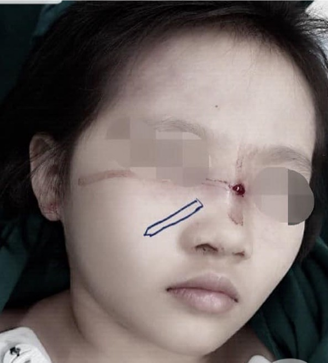 Bé gái bị bút chì đâm xuyên qua mũi khi giành nhau với chị - ảnh 2