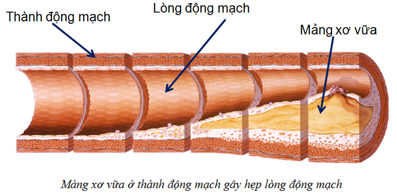 Chàng trai 28 tuổi bất ngờ bị nhồi máu cơ tim suýt chết  - ảnh 2