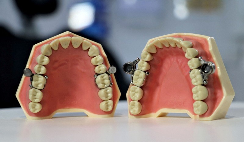 Thiết bị khóa chặt hàm răng giúp người dùng giảm cân - ảnh 1
