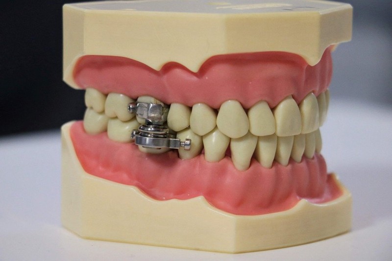 Thiết bị khóa chặt hàm răng giúp người dùng giảm cân - ảnh 2