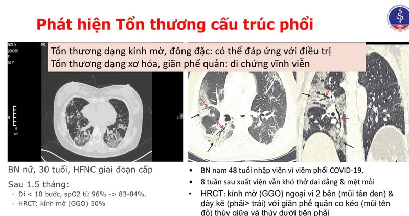 Hậu COVID-19, người phụ nữ 30 tuổi chưa đi nổi 10 bước oxy đã giảm 10% - ảnh 1