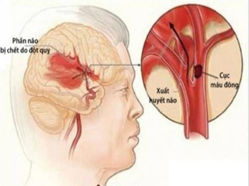 Phân loại các dạng đột quỵ