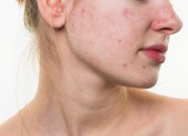 8 biểu hiện trên da báo nguy cho sức khỏe