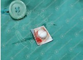 Ho ra máu vì uống nhầm viên thuốc chưa bóc vỏ