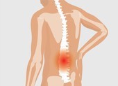 Cảnh báo viêm khớp cột sống gây tàn phế người trẻ