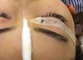Nhấn mí làm đẹp, cô gái bị cây kim 'chơi ú tim' trong mắt